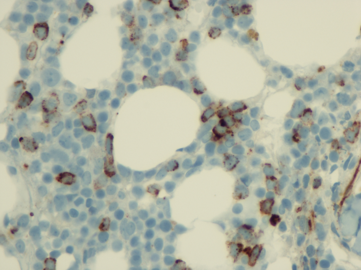 CD34 immunostain is positive in blasts, comprising approximately 10-12% of marrow cellularity